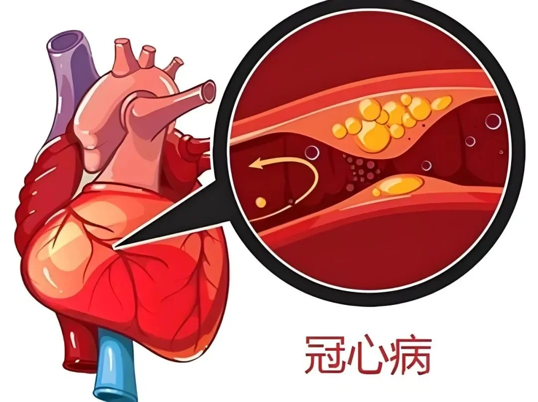 别让心脏在冬天“憋气”！近期高发的冠心病，这些信号要认清