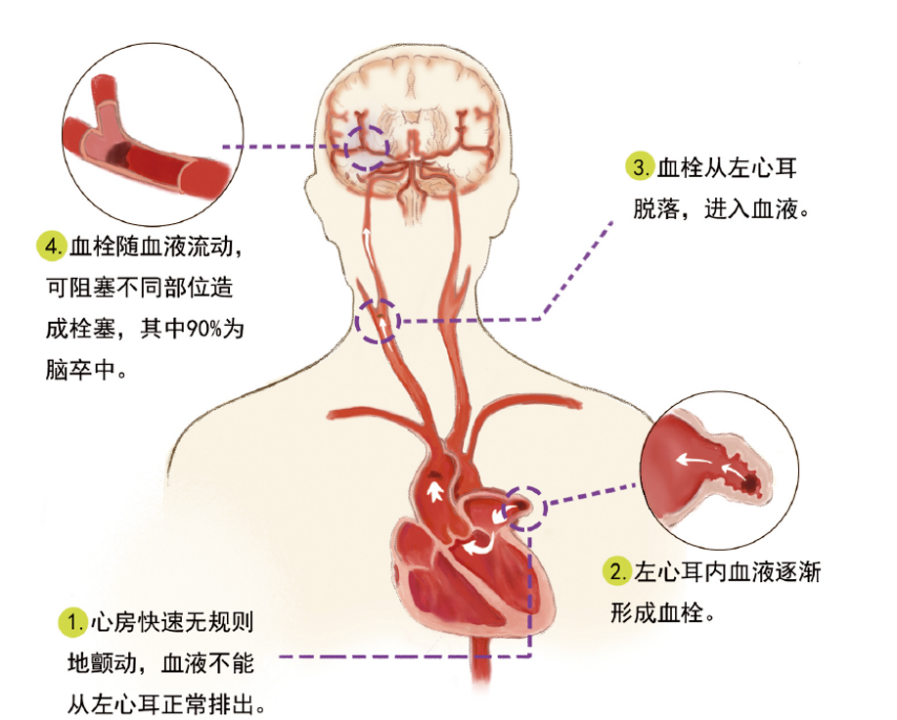 心跳忽快忽慢别忽视，读懂心房颤动